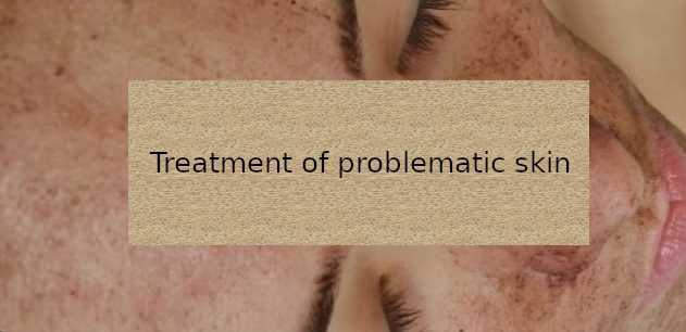 You are currently viewing Treatment of problematic skin