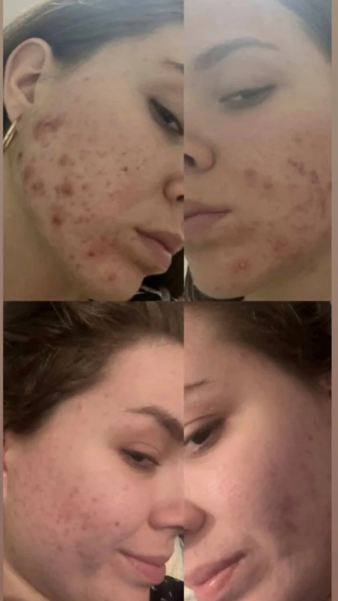 Real Transformation: The Journey to Clear Skin