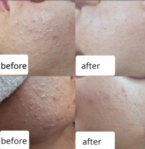 Read more about the article Real Transformation: The Journey to Clear Skin