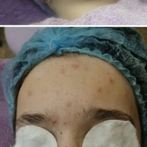 Treatment of problematic skin2